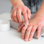 Psoriasis and Its Treatments